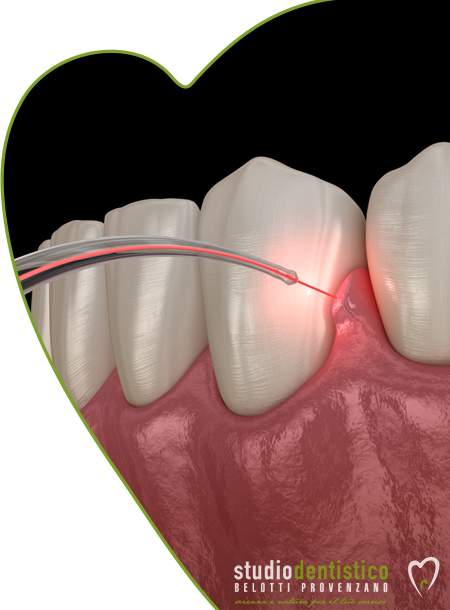 Laser terapia