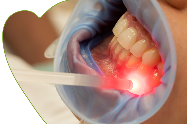 Laser terapia