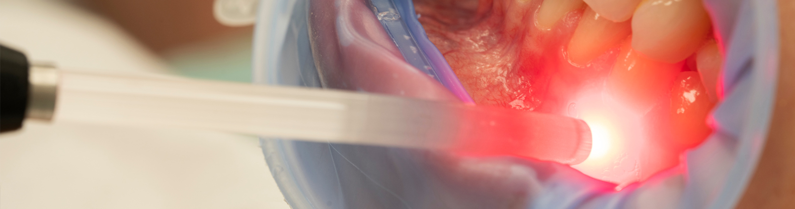 Laser terapia